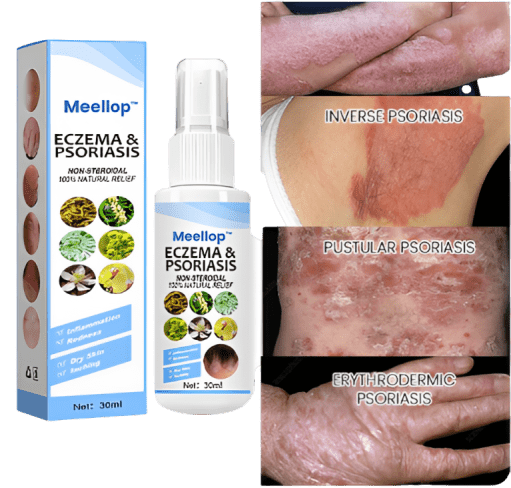 Herbal Psoriasis Relief Spray 🔥 Buy 1 Get 1 Free 🔥