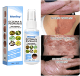 Herbal Psoriasis Relief Spray 🔥 Buy 1 Get 1 Free 🔥